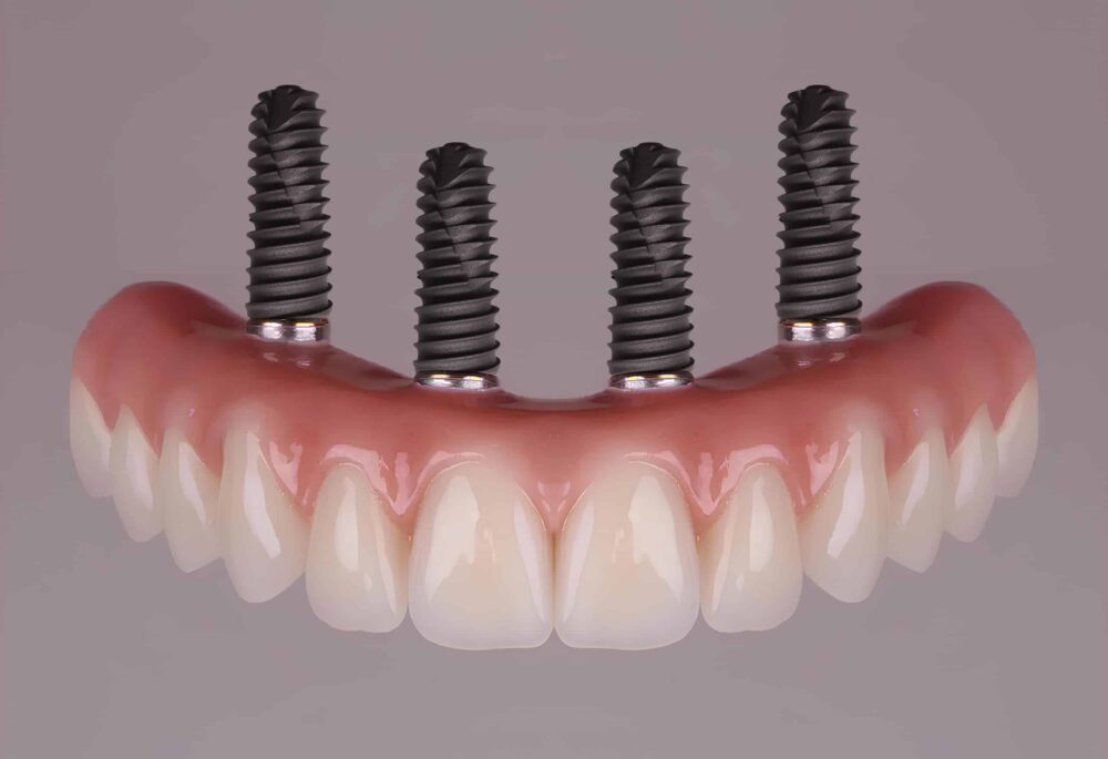 All-on-4 Dental Implants Holladay