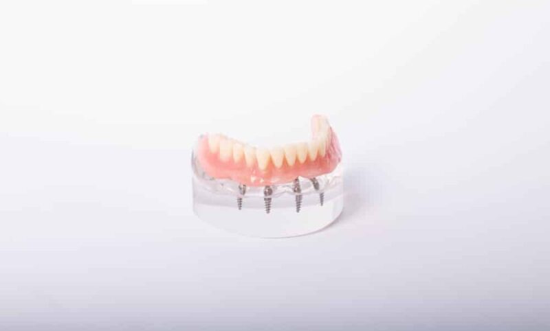 Implant-Supported Dentures Holladay