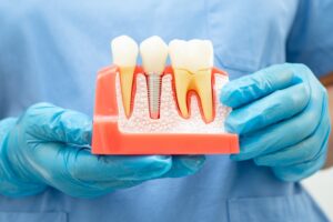 Dental Implants Holladay